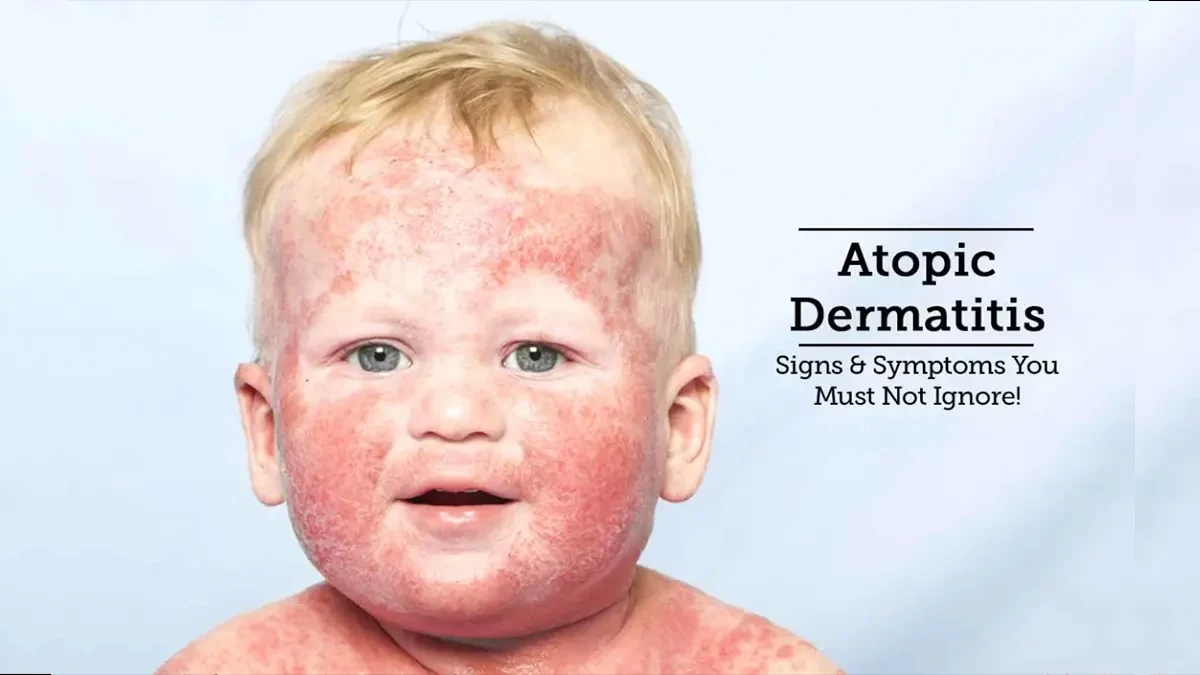 Atopic Dermatitis in Children - Causes and Treatment