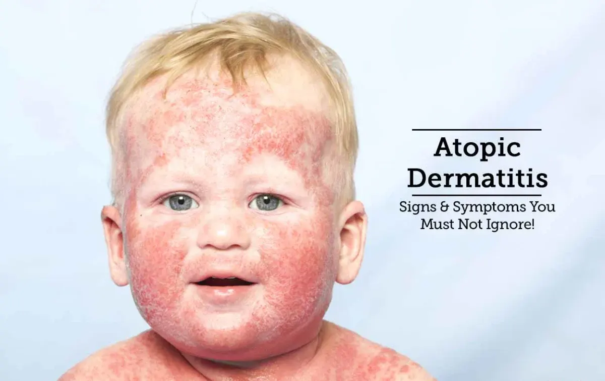  Atopic Dermatitis in Children - Causes and Treatment