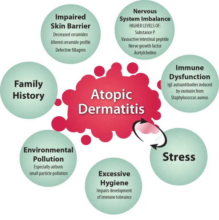  Atopic Dermatitis in Children - Causes and Treatment