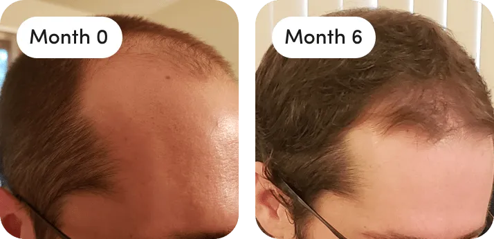 What Is The Difference Between Minoxidil And Finasteride