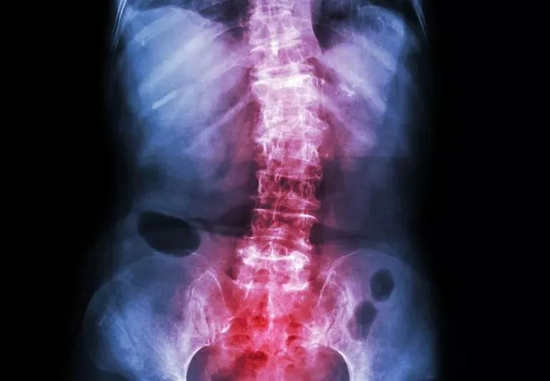 Facts About Adult Scoliosis