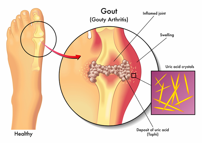 gout in foot