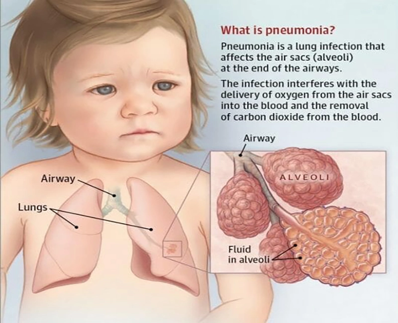 Pneumonia in Children: A Guide to Home Care