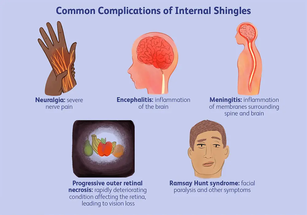 Symptoms of Shingles on the Skin